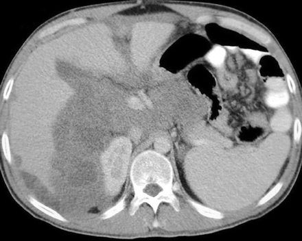 Peritoneal Mesothelioma Facts You Need to Know