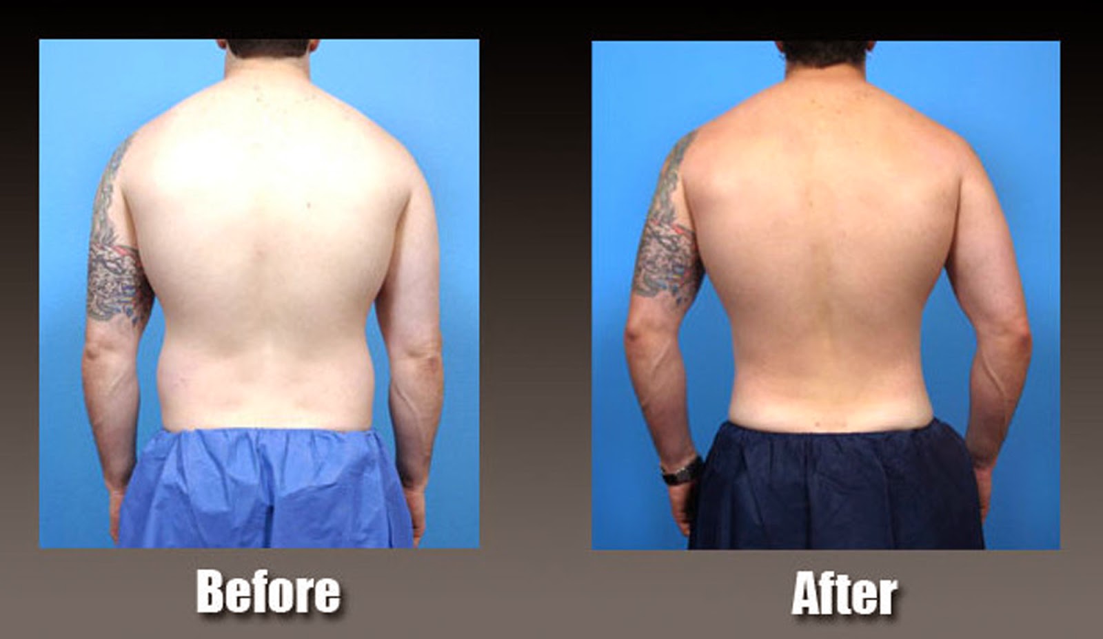 Liposuction Las Vegas