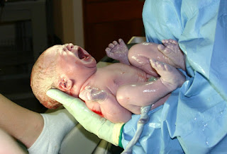 Yeni doğmuş bir bebeğin cildi üzerinde amniyon sıvısı görülüyor.