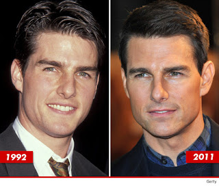 tom-cruise-surgery-before-after