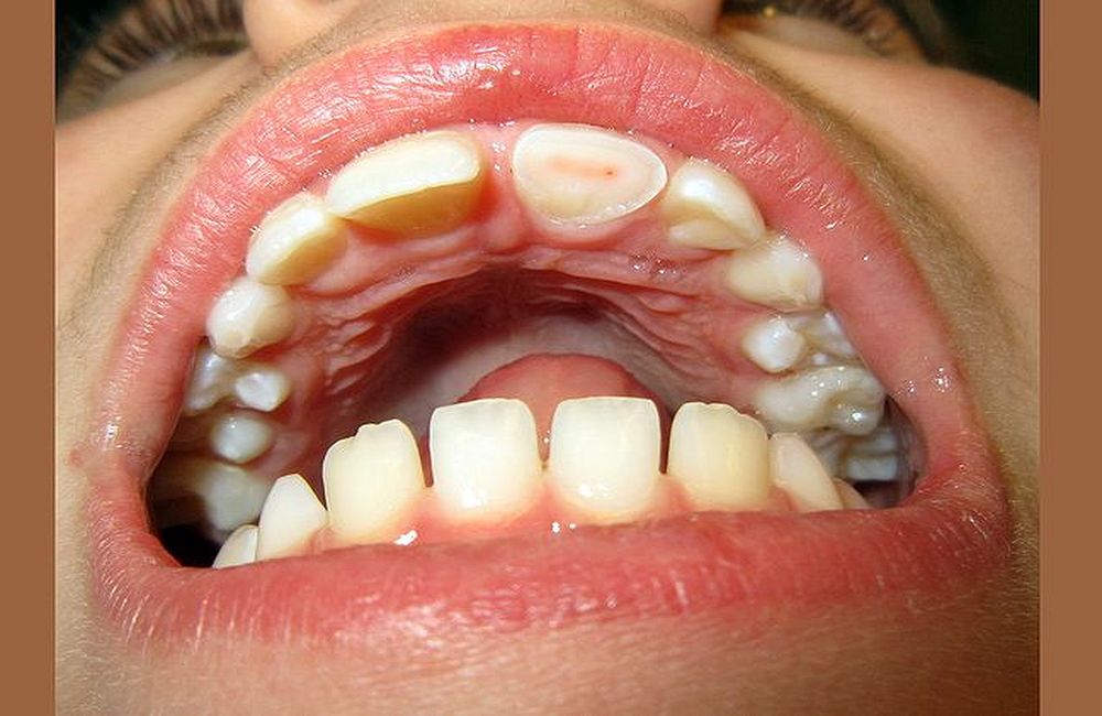 Acidentes Dentários