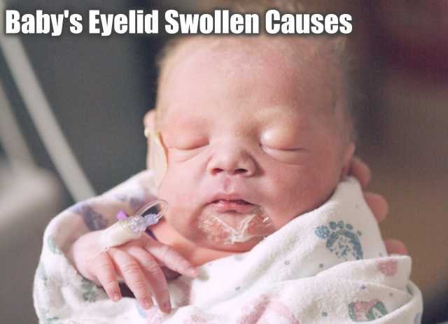 Why-Baby-Eyelid-Swollen