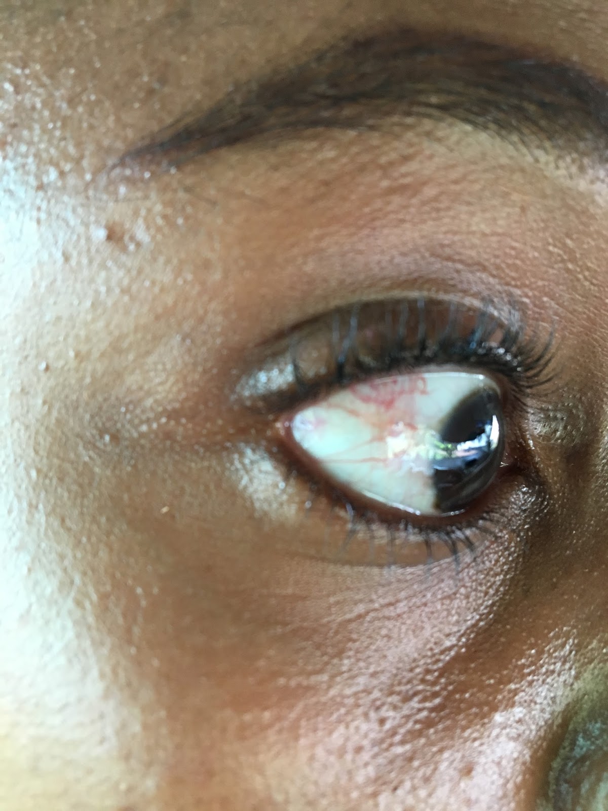 How to get rid of a brown spot / discolouration on the whites of the eye / sclera