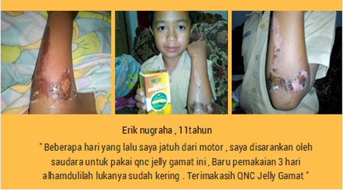 Cara Menyembuhkan Borok Di Kepala Secara Alami Terbukti Manjur - TESTIMONI JELLY GAMAT QNC Cara Menyembuhkan Borok Di Kepala Secara Alami Terbukti Manjur - TESTIMONI JELLY GAMAT QNC