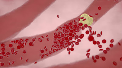 kolestrol yang tinggi boleh menyebabkan SALURAN DARAH TERSUMBAT