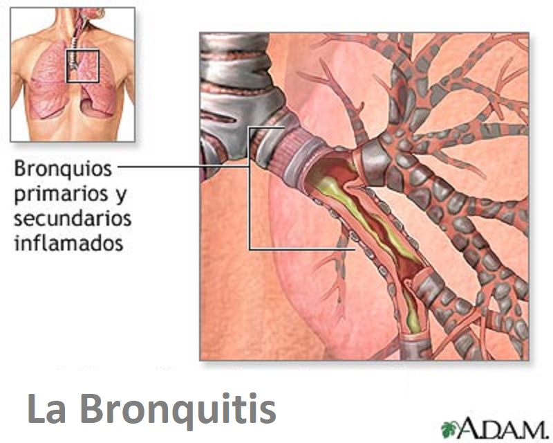 bronquitis