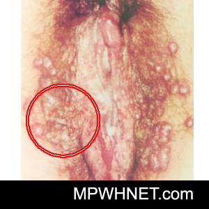 Dermnet: Dermatology Pictures - Skin Disease Pictures