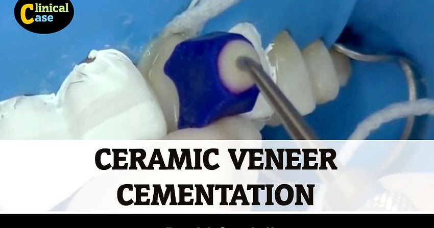 CERAMIC VENEER: Cementation using pre heated restorative composite