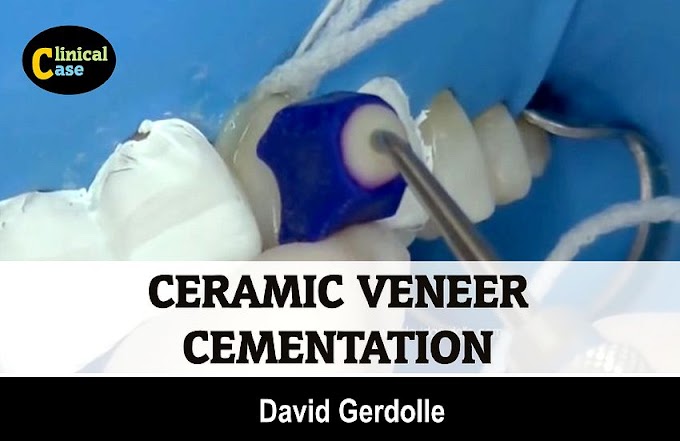 CERAMIC VENEER: Cementation using pre heated restorative composite - David Gerdolle