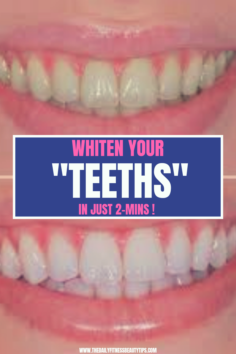 How To Whiten Your Teeth At Home Just In 2Minutes?