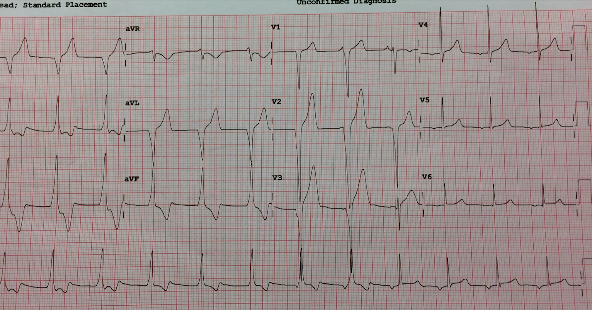 Dr. Smith's ECG Blog An adolescent with trauma, chest pain, and a wide