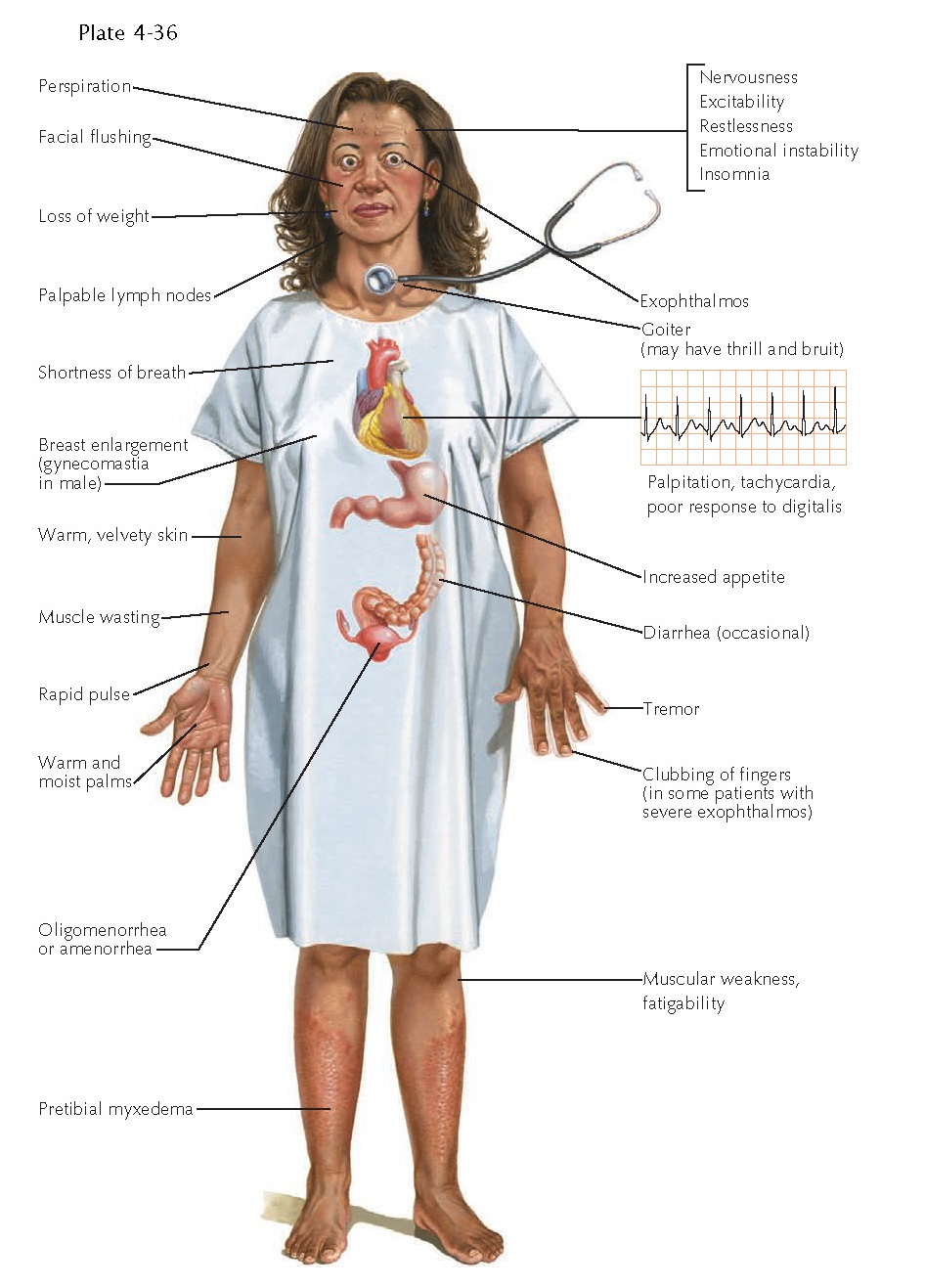 GRAVES DISEASE AND PRETIBIAL MYXEDEMA pediagenosis