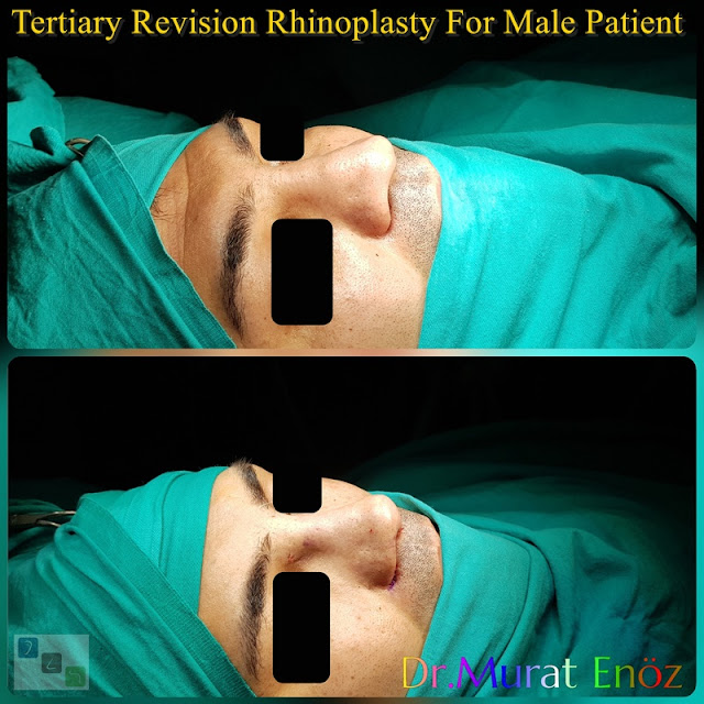 Tertiary Revision Rhinoplasty For Male Patient - Alar Base Resection - 3rd Revision Nose Job With Cadaveric Rib Cartilage - Revision Nose Aesthetic Doctor in Istanbul