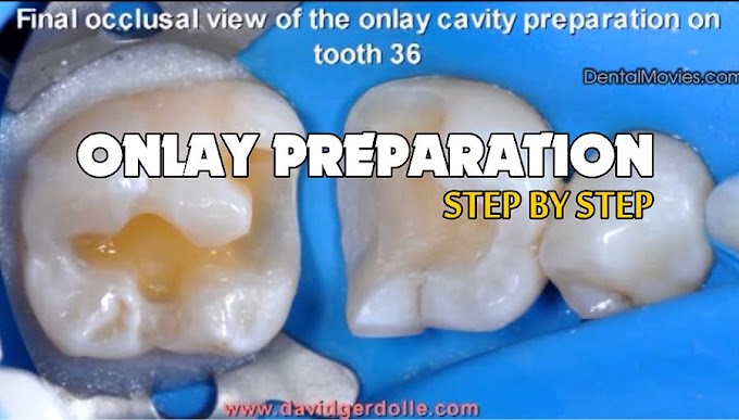 ONLAY PREPARATION: On tooth 36 with distal margin coronal relocation - Step by Step