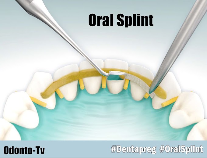 DENTAPREG: Oral Splint