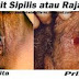 Obat Sifilis Apotek