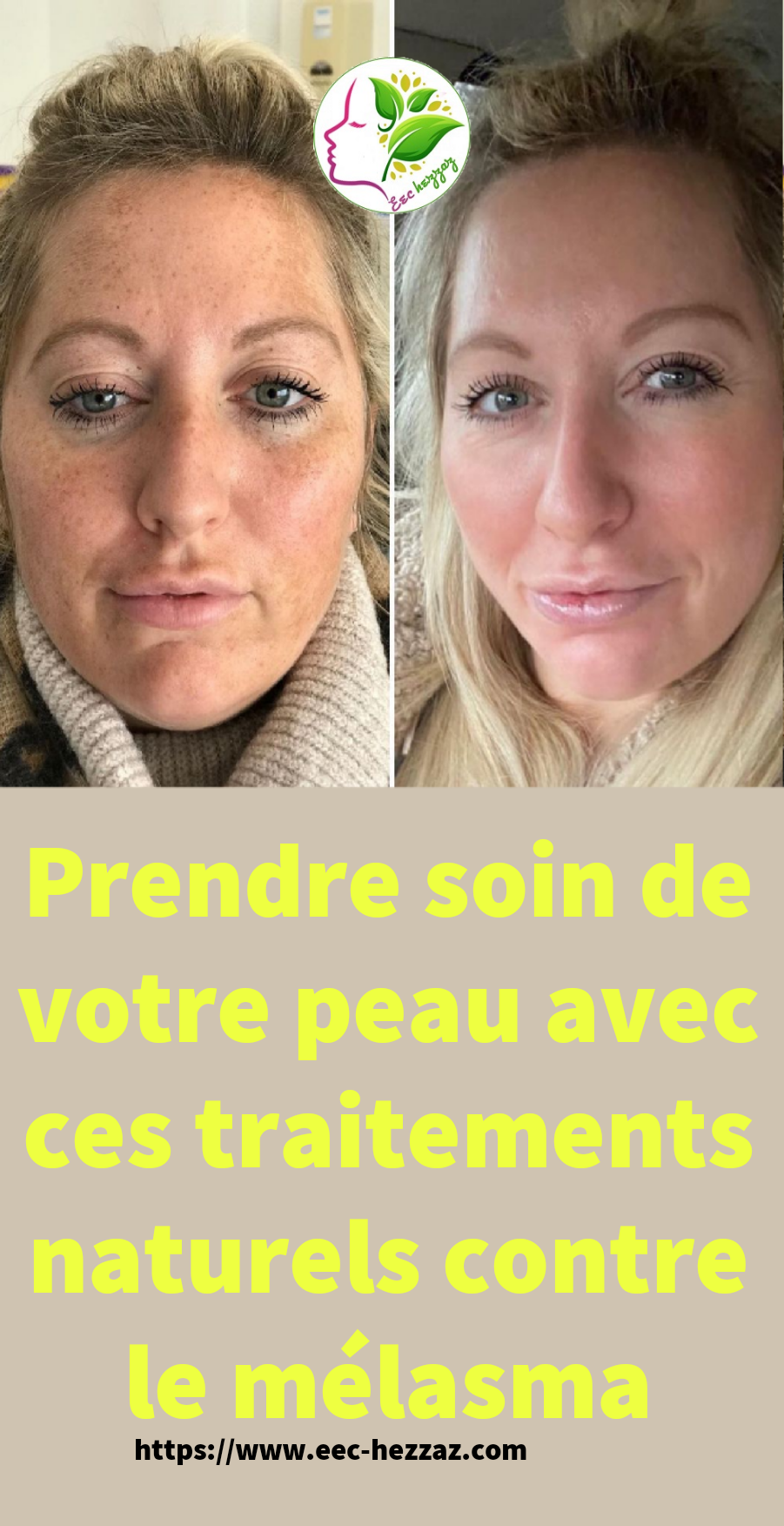 Prendre soin de votre peau avec ces traitements naturels contre le mélasma