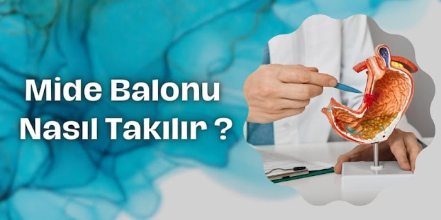 Mide Balonu Nasıl Takılır?