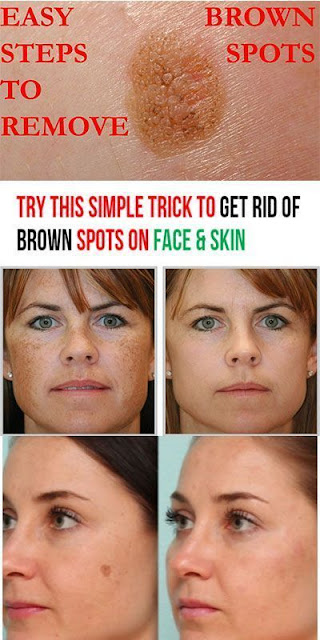 Try This Simple Trick to Get Rid of Brown Spots on Face & Skin ...