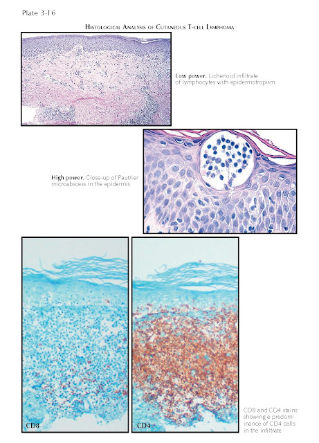 Histological Analysis Of Cutaneous T-Cell Lymphoma