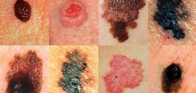 أنواع سرطان الجلد أنواع سرطان الجلد