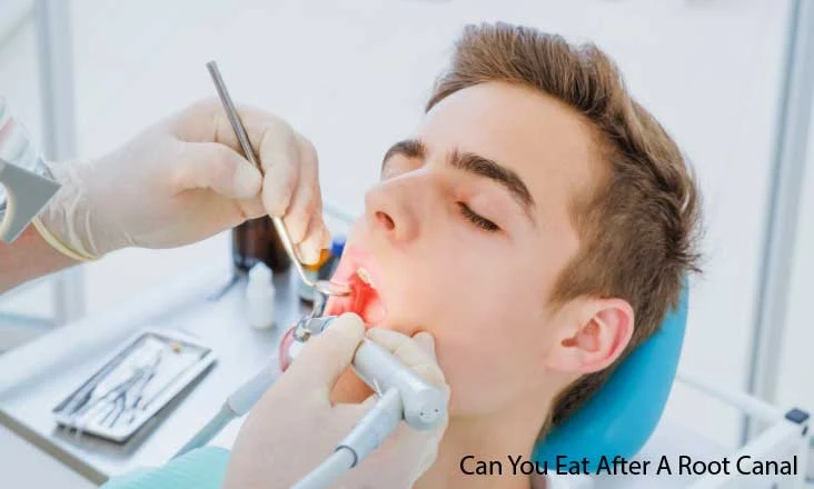 What Can You Eat After A Root Canal Treatment?