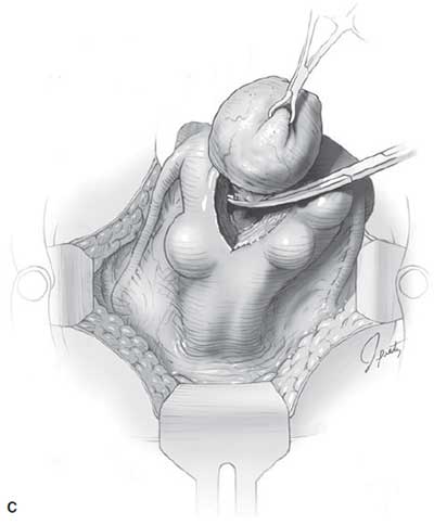 Removal of fibroid from myometrium