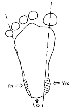silviaquerida: The Heelstick Procedure