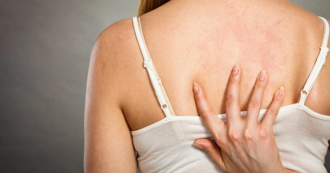 menghilangkan jerawat di area punggung