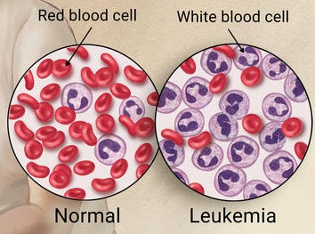 Ciri-ciri dan Gejala Penyakit Leukemia | Twet News
