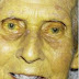 Jaundice is a common illness in the world | Doctors Gang Hepatology