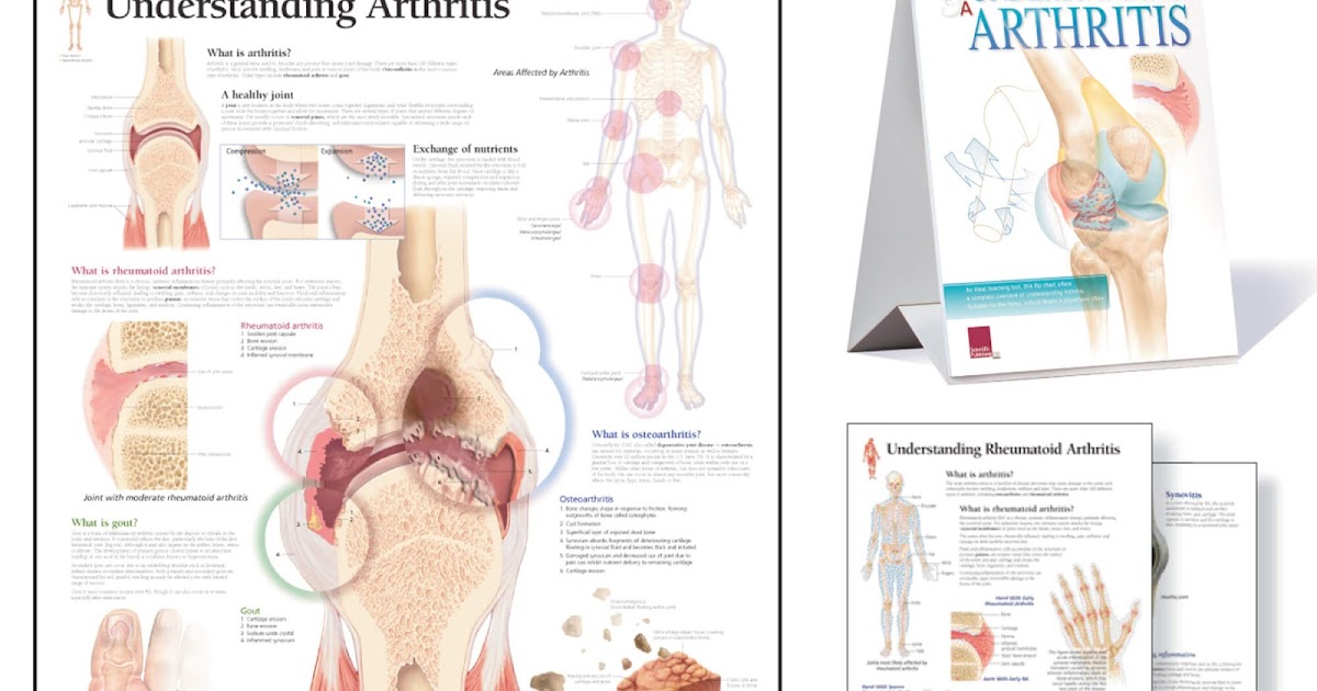 WeCare Rheumatoid Arthritis vs. Osteoarthritis, Chinese Medicine Approaches to Relieve Arthritis