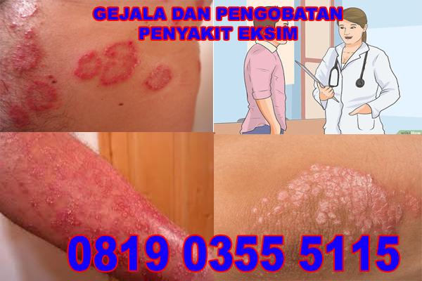 Obat Bintik Bintik Dan Gatal Gatal Pada Kemaluan