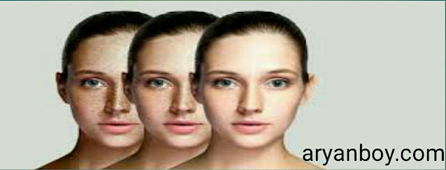 पुराने से पुराने झाइयां दूर करने के उपाय - Hyperpigmentation Treatment