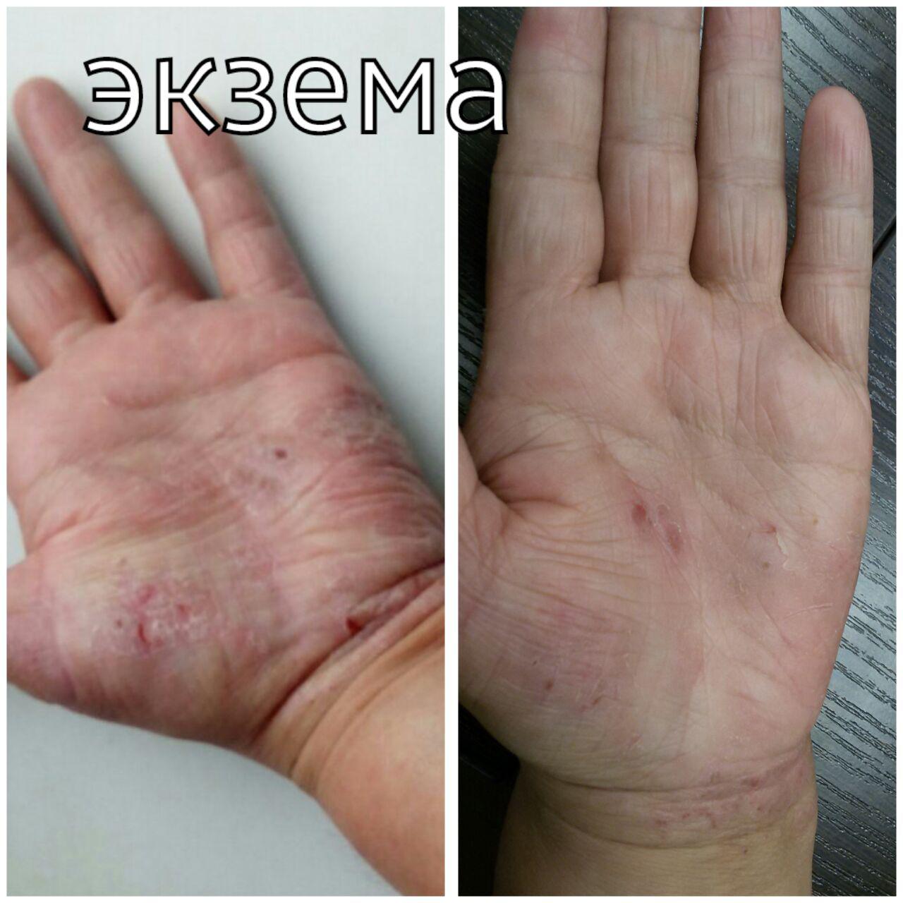 Густые белые выделения без запаха и зуда: причины появления и поэтапное лечение Густые белые выделения без запаха и зуда: причины появления и поэтапное лечение