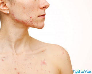 how to get rid of chest acne,how to get rid of acne on chest,how to get rid of back acne,how to get rid of back and chest acne,female chest acne,tiny pimples on chest,what causes pimples on chest and back,how to get rid of body acne overnight,chest acne pictures,how to get rid of chest acne home remedies,chest acne pregnancy,acne men