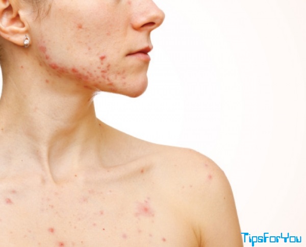 Chest Acne: What Causes It and 12 Ways to Get Rid of Chest Acne Fast