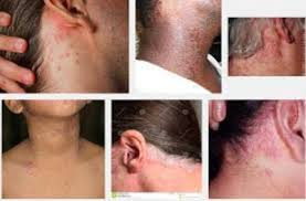 NAMA OBAT GATAL EKSIM DI LEHER PALING MANJUR DI APOTEK NAMA OBAT GATAL EKSIM DI LEHER PALING MANJUR DI APOTEK