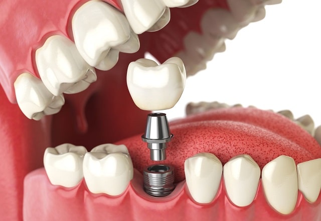 how to save money on dental implants frugal tooth implant