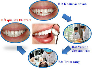 Điều trị sâu răng hiệu quả Quy-trinh-tram-rang-uy-tin-tai-nha-khoa-Duy-Hung