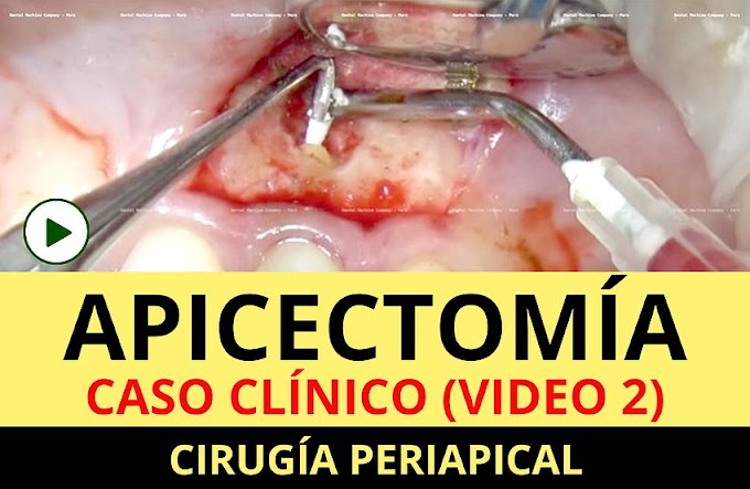 APICECTOMÍA: Cirugía Periapical - Caso Clínico (Video 2) - Carlos Fernando Ruiz Laos