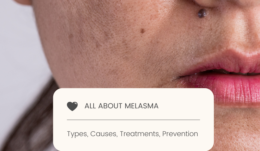 WHAT CAUSES MELASMA? Treatments, Types, Prevention