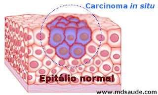 Carcinoma in situ