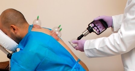 Bekam (Pengertian, Manfaat, Jenis dan Langkah-langkahnya)