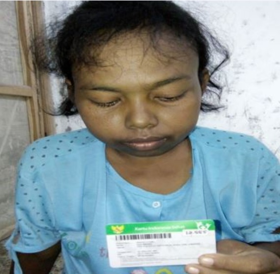 Mojokerto – majalahglobal.com : Hemodialisis adalah prosedur medis yang bertujuan untuk menggantikan fungsi ginjal akibat kerusakan pada organ tersebut atau di kalangan masyarakat umum lebih dikenal dengan cuci darah. Hal ini dialami oleh Ngatmining (40) yang merupakan salah satu peserta segmen Penerima Bantuan Iuran (PBI) Jaminan Kesehatan Nasional - Kartu Indonesia Sehat (JKN-KIS) yang berasal dari Desa Kepuhrejo Kecamatan Kudu Mojokerto. Ia terdiagnosa mengalami kerusakan ginjal pada awal tahun 2019 lalu sehingga mengharuskannya menjalani pengobatan hemodialisis.  “Saya diharuskan melakukan kontrol dan cuci darah setiap bulannya agar kondisi saya dapat terpantau secara optimal dan bisa berangsur membaik” tuturnya.  Ia menceritakan selama menjalani pengobatan, ia tidak pernah mengeluarkan biaya sama sekali. Hal tersebut sangat membantunya, mengingat ia dan keluarganya adalah keluarga yang tergolong tidak mampu.  “Alhamdulillah saya sangat bersyukur sekali bisa melakukan cuci darah setiap bulannya ke Rumah Sakit Soekandar Mojosari Kabupaten Mojokerto sekalipun status kepesertaaan JKN-KIS saya hanya kelas 3 saya bersyukur tidak pernah mengeluarkan biaya sama sekali,” ungkap wanita asal Desa Kepuhrejo ini.  Ngatmining juga mengungkapkan selama masa pandemi Covid-19 pelayanan pengobatan di Fasilitas Kesehatan Tingkat Pertama (FKTP) dan Fasilitas Kesehatan Rujukan Tingkat Lanjutan (FKRTL) sama optimalnya dengan sebelum adanya masa pandemi ini. Sehingga ia tetap bisa melakukan kontrol secara rutin setiap bulannya sesuai anjuran dokter.  “Tidak ada perbedaan pelayanan di FKTP maupun FKRTL. Termasuk layanan pengobatan yang saya terima juga masih tetap sama baiknya dengan sebelum adanya Covid-19 ini. Bahkan ketika saya rawat inap pun, saya mendapat pelayanan yang sama baiknya meskipun saya hanya peserta PBI yang iurannya dibantu oleh pemerintah,” ujar Ngatmining.  Ngatmining berharap keberlangsungan program JKN-KIS ini akan terus ada sehingga akan sangat membantu masyarakat yang kurang mampu. Berkat program ini masyarakat yang kurang mampu tetap bisa mendapatkan jaminan pelayanan berobat tanpa memikirkan biaya yang besar. (Jayak)