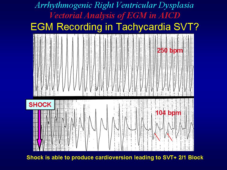 ARVCsGF: Vectorial interpretation of VT/SVT signals stored in the ICD