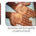 What is syphilis: pathogenesis and morphology