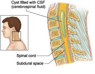 myelomalacia symptoms