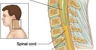 myelomalacia definition causes