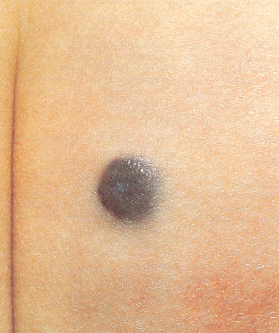 blue nevus pictures